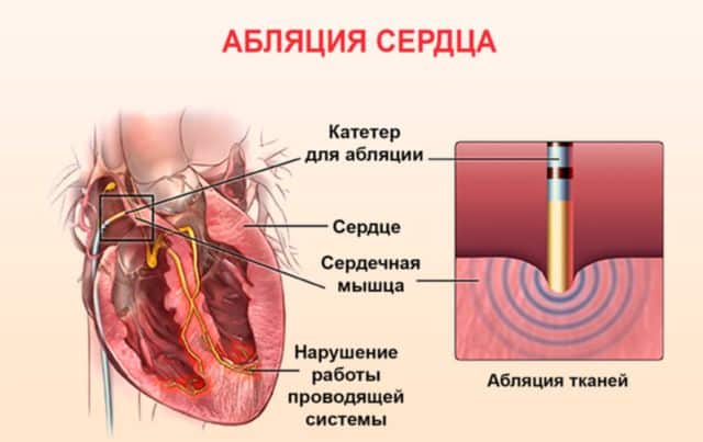 Абляция сердца при мерцательной аритмии.